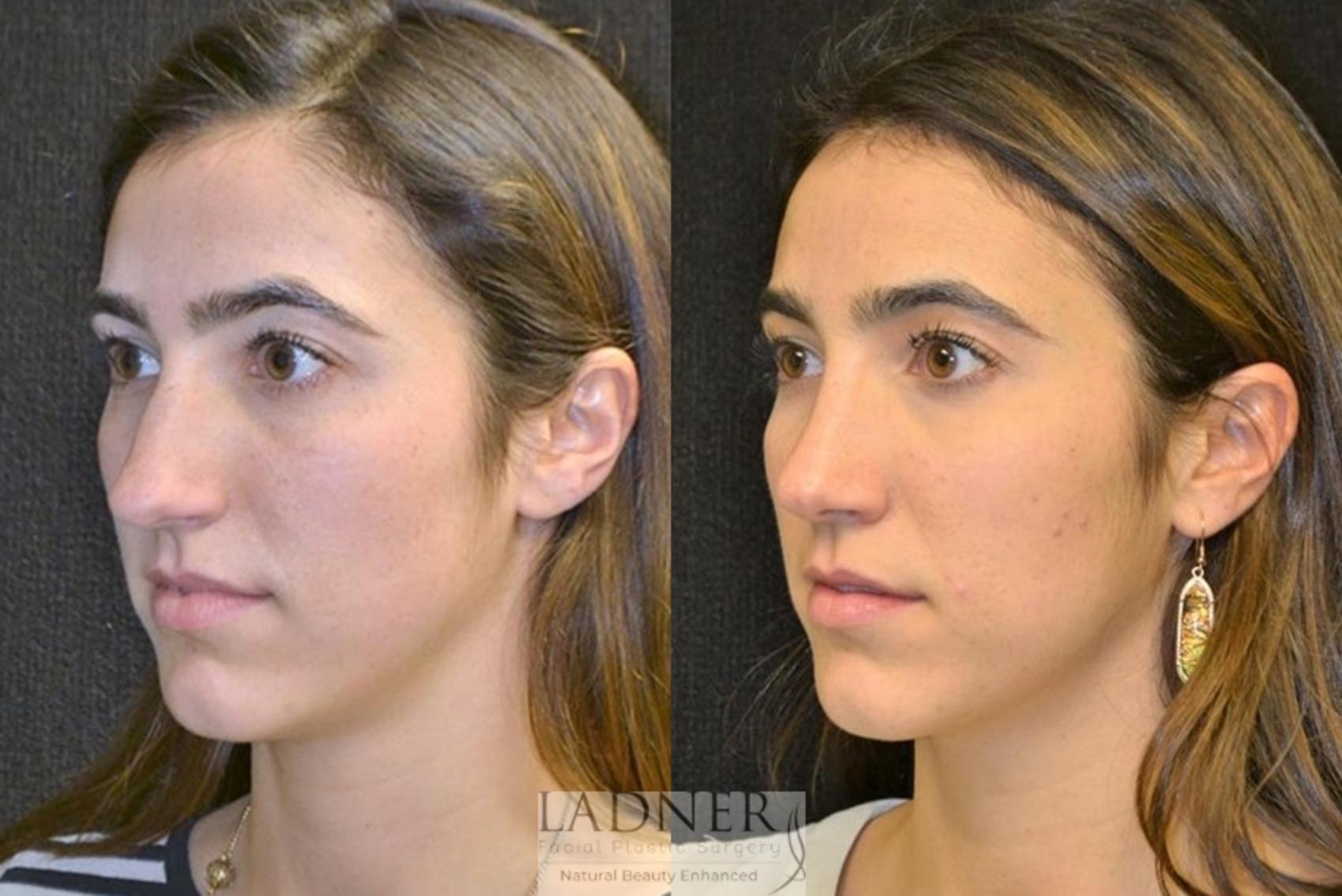 Rhinoplasty (Nose job) Case 43 Before & After Left Oblique | Denver, CO | Ladner Facial Plastic Surgery