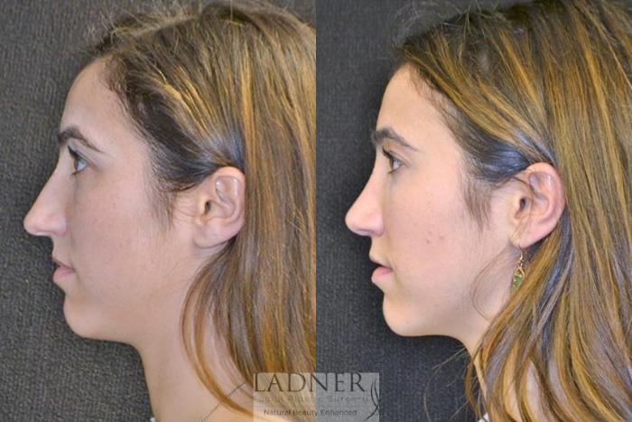Rhinoplasty (Nose job) Case 43 Before & After Left Side | Denver, CO | Ladner Facial Plastic Surgery
