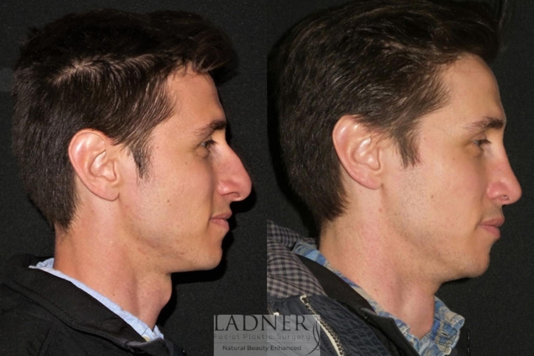 Rhinoplasty (Nose job) Case 44 Before & After Right Side | Denver, CO | Ladner Facial Plastic Surgery
