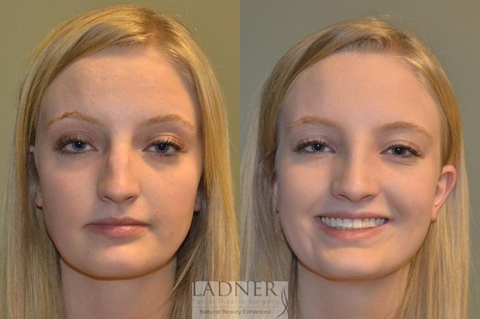 Rhinoplasty (Nose job) Case 45 Before & After Front | Denver, CO | Ladner Facial Plastic Surgery