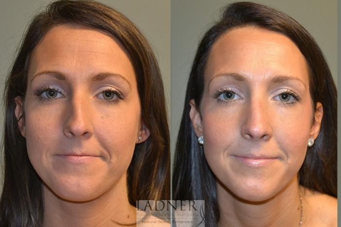 Rhinoplasty (Nose job) Case 47 Before & After Front | Denver, CO | Ladner Facial Plastic Surgery