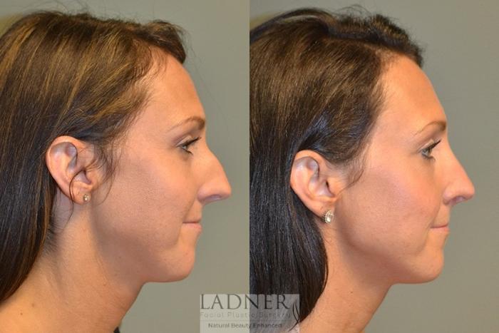 Rhinoplasty (Nose job) Case 47 Before & After Right Side | Denver, CO | Ladner Facial Plastic Surgery