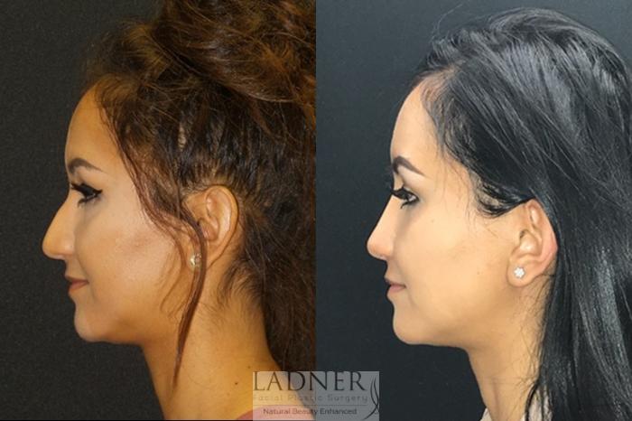 Rhinoplasty (Nose job) Case 48 Before & After Left Side | Denver, CO | Ladner Facial Plastic Surgery