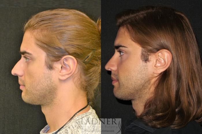Facial Plastic Surgery for Men Case 5 Before & After Left Side | Denver, CO | Ladner Facial Plastic Surgery
