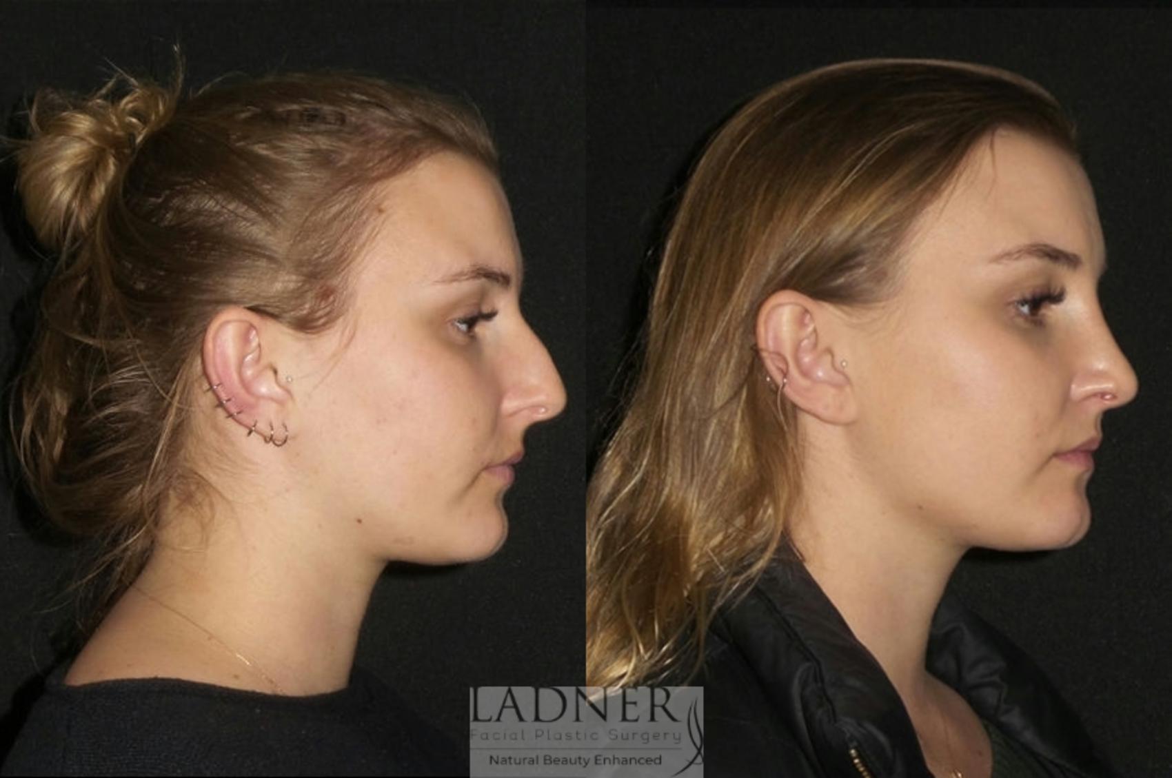 Rhinoplasty (Nose job) Case 7 Before & After Right Side | Denver, CO | Ladner Facial Plastic Surgery
