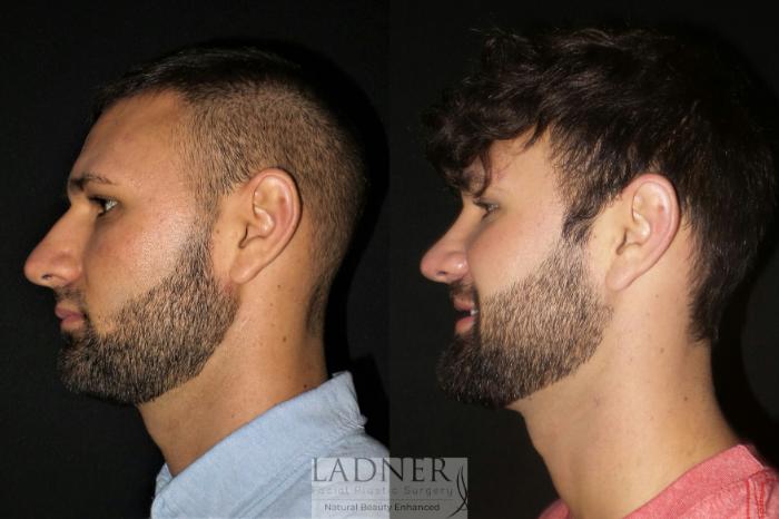Rhinoplasty (Nose job) Case 79 Before & After Left Side | Denver, CO | Ladner Facial Plastic Surgery