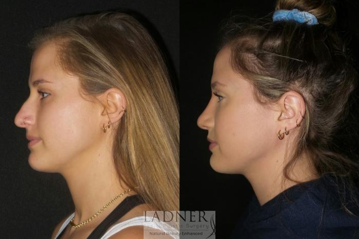 Rhinoplasty (Nose job) Case 80 Before & After Left Side | Denver, CO | Ladner Facial Plastic Surgery