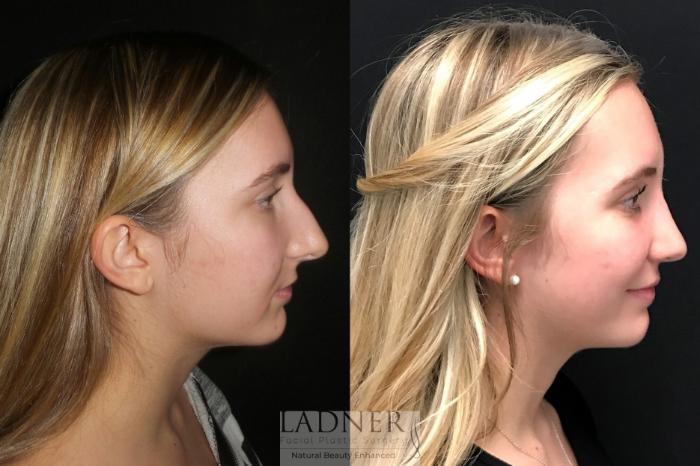 Rhinoplasty (Nose job) Case 82 Before & After Right Side | Denver, CO | Ladner Facial Plastic Surgery