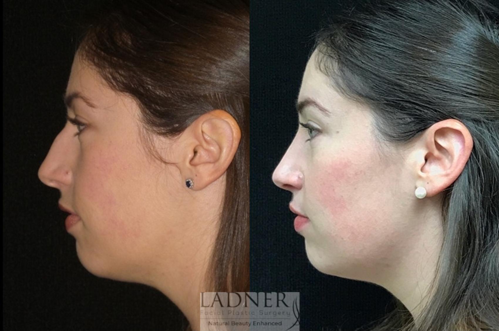 Rhinoplasty (Nose job) Case 9 Before & After Left Side | Denver, CO | Ladner Facial Plastic Surgery