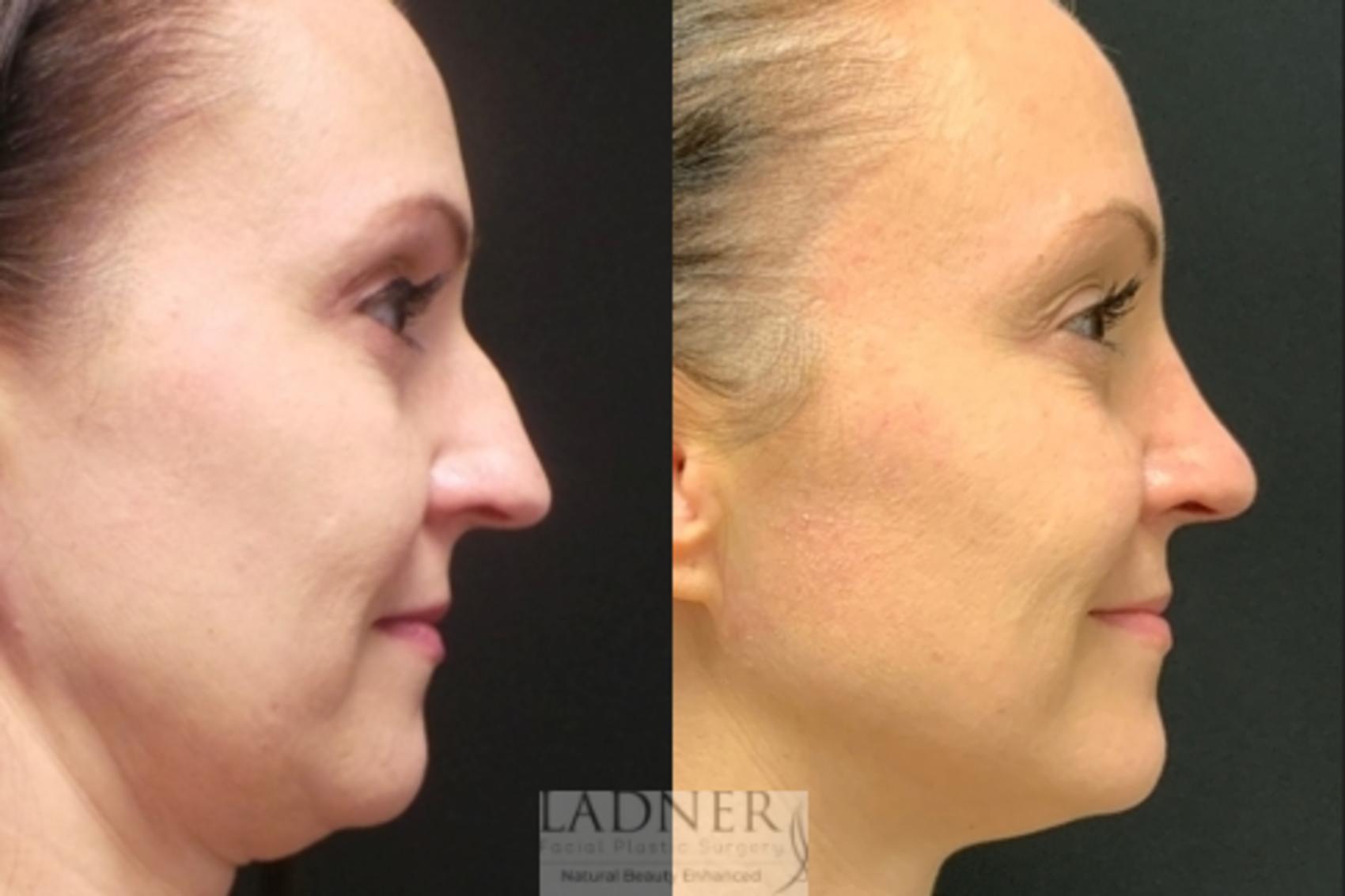 Rhinoplasty (Nose job) Case 90 Before & After Right Side | Denver, CO | Ladner Facial Plastic Surgery
