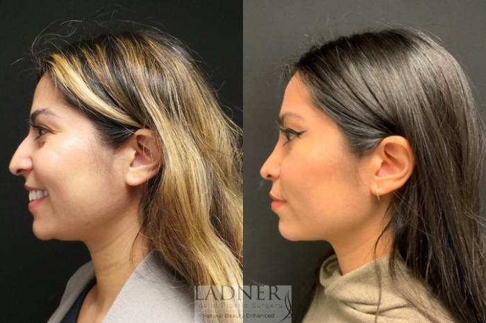 Rhinoplasty (Nose job) Case 92 Before & After Left Side | Denver, CO | Ladner Facial Plastic Surgery