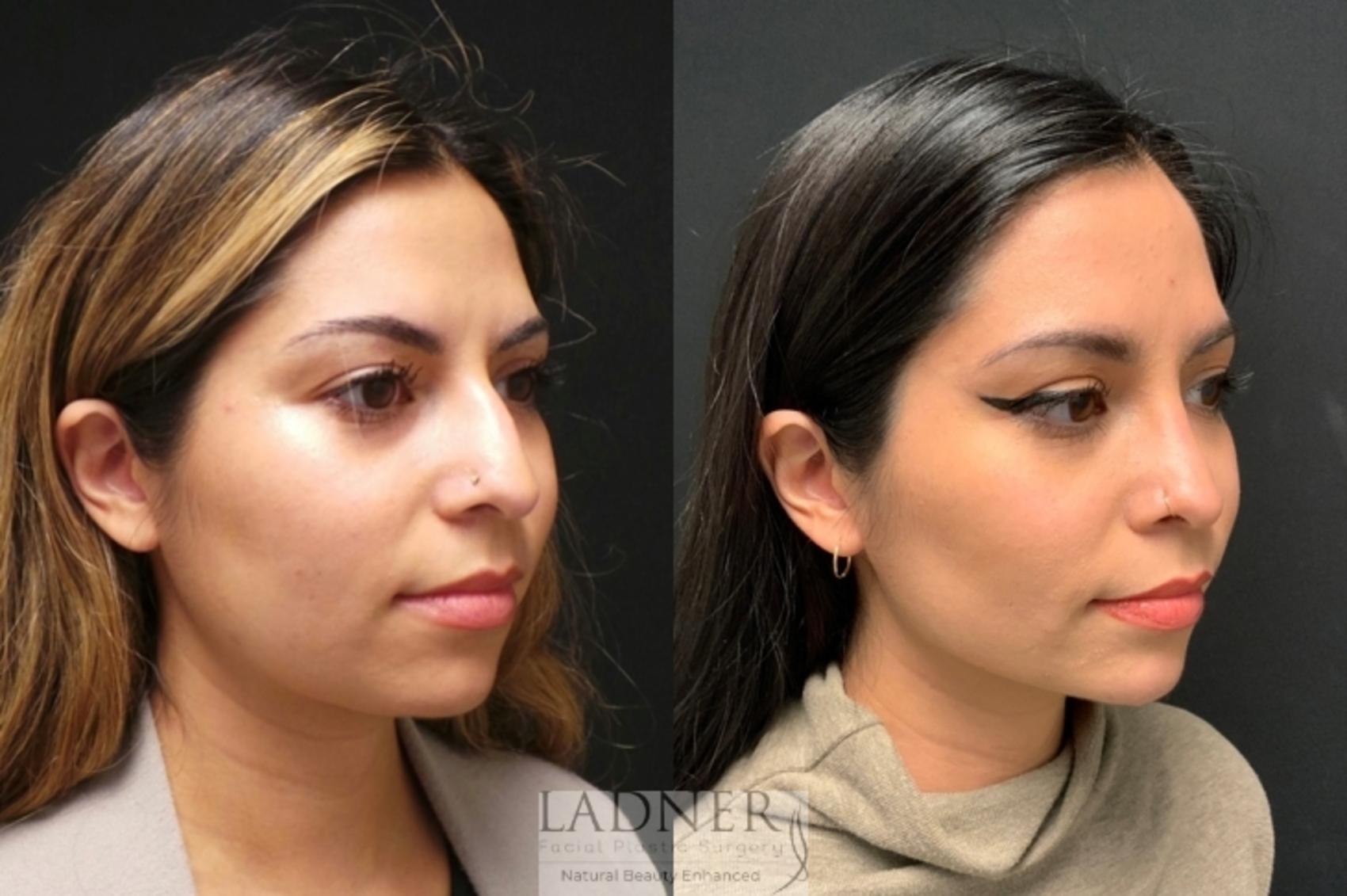 Rhinoplasty (Nose job) Case 92 Before & After Right 3/4 View | Denver, CO | Ladner Facial Plastic Surgery