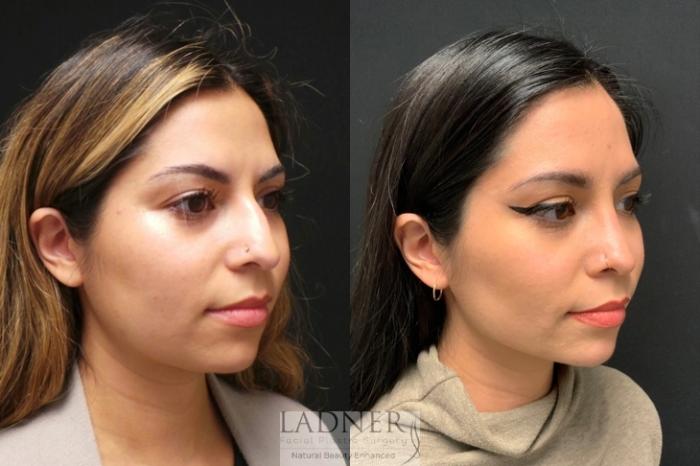 Rhinoplasty (Nose job) Case 92 Before & After Right 3/4 View | Denver, CO | Ladner Facial Plastic Surgery