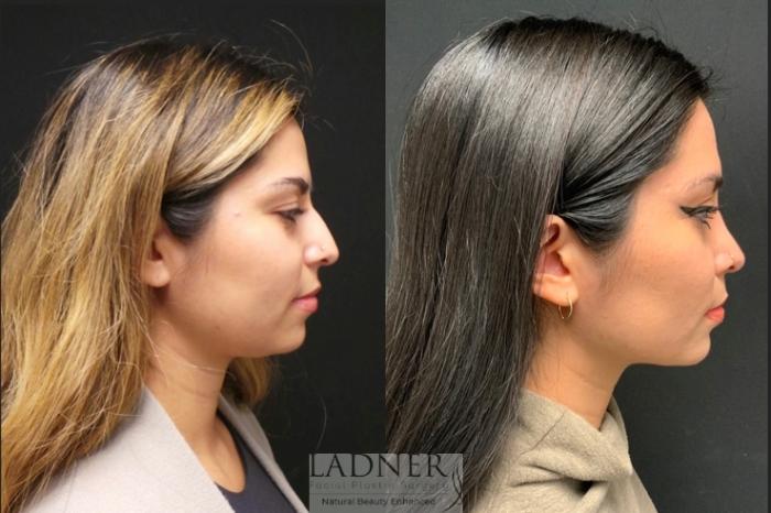 Rhinoplasty (Nose job) Case 92 Before & After Right Side | Denver, CO | Ladner Facial Plastic Surgery