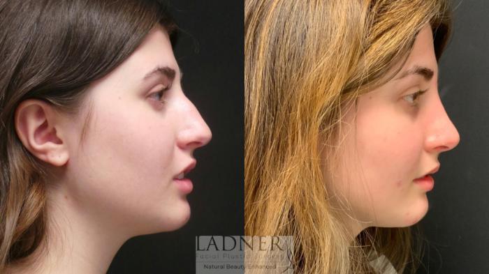 Rhinoplasty (Nose job) Case 95 Before & After Right Side | Denver, CO | Ladner Facial Plastic Surgery