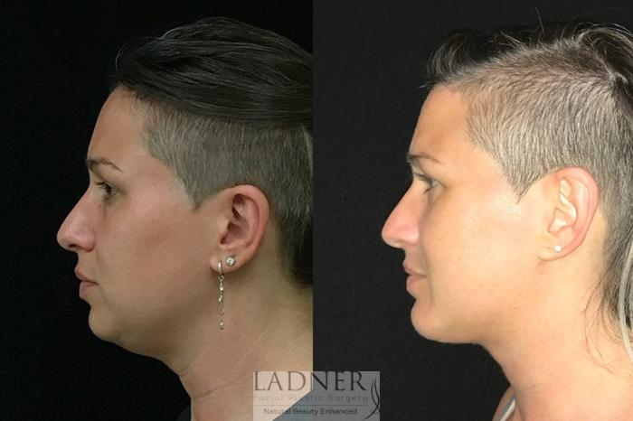 Submental Liposuction Case 71 Before & After Left Side | Denver, CO | Ladner Facial Plastic Surgery