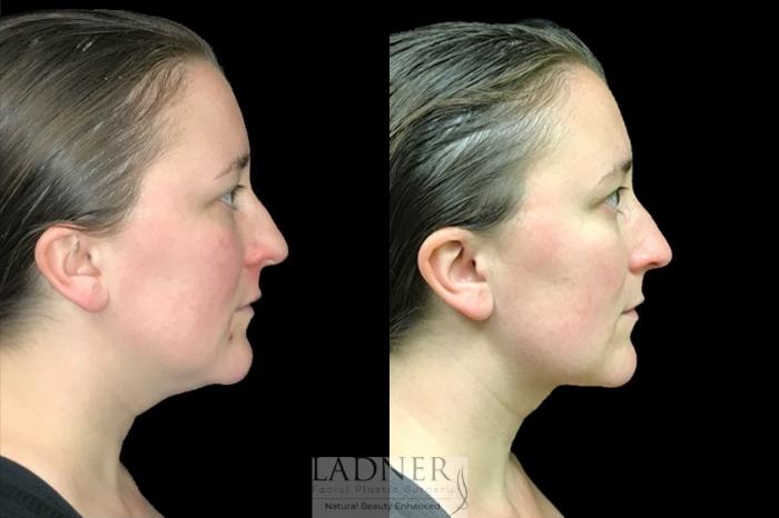 Submental Liposuction Case 72 Before & After Right Side | Denver, CO | Ladner Facial Plastic Surgery
